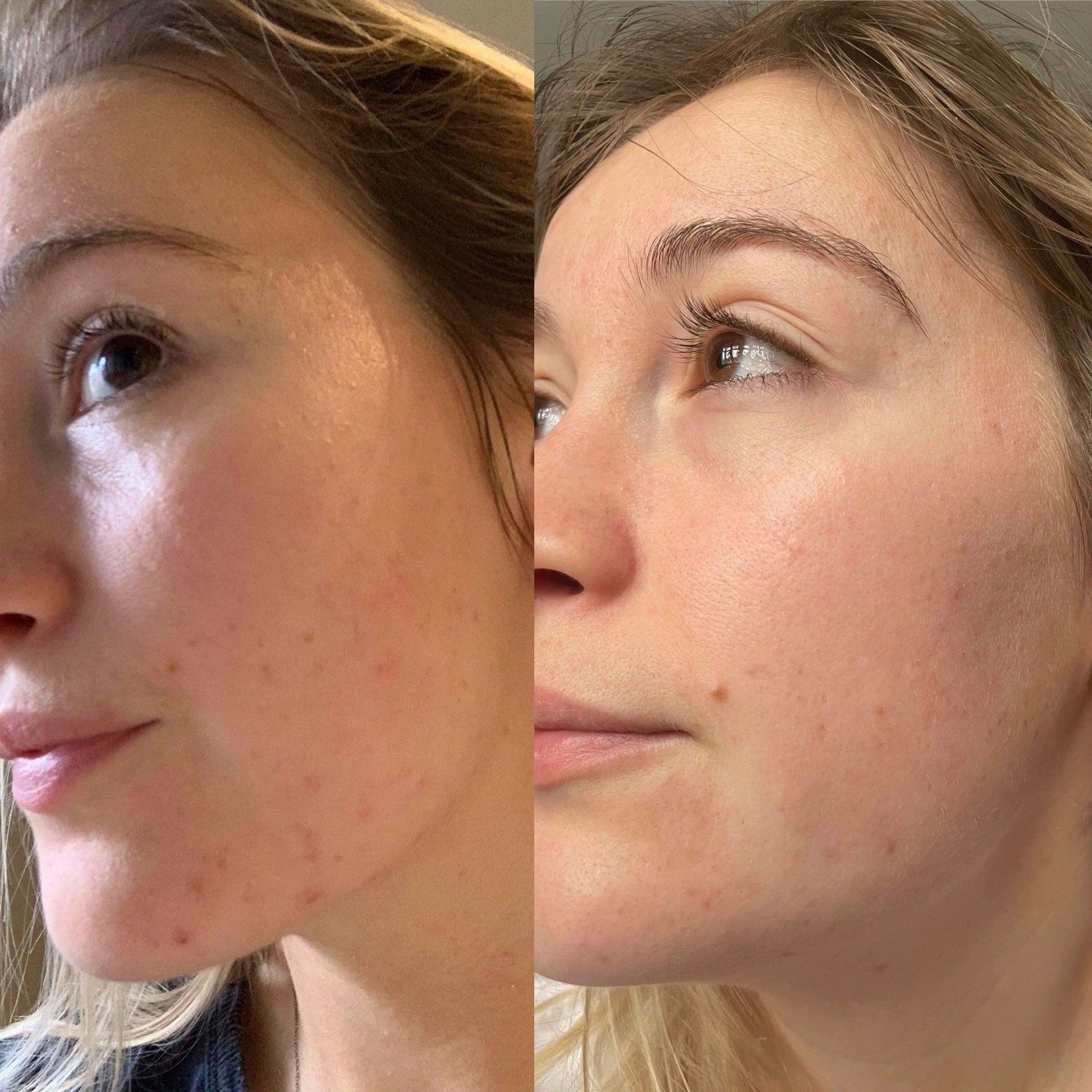 Argan Acne Rehab Serum 30ml Plant Based Formula for Acne Prone Skin