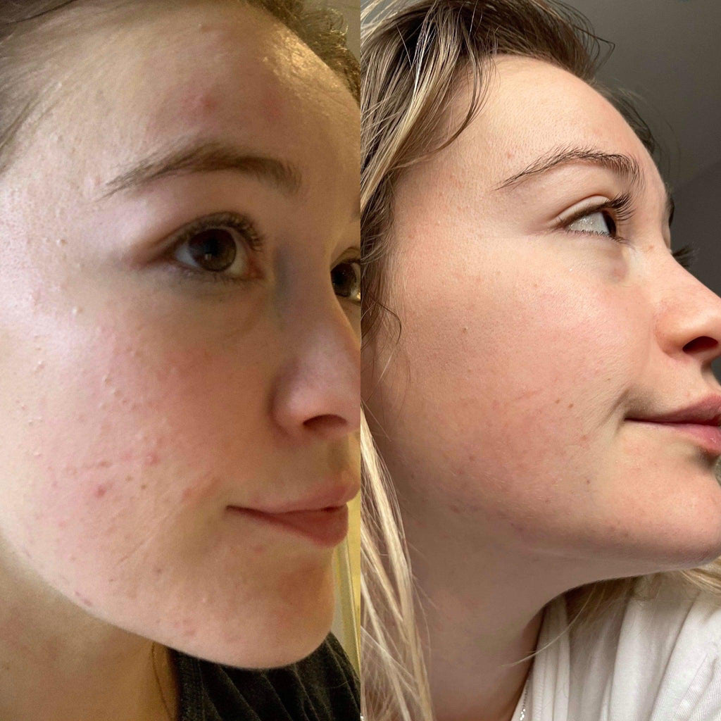 Argan Acne Rehab Serum 30ml Plant Based Formula for Acne Prone Skin