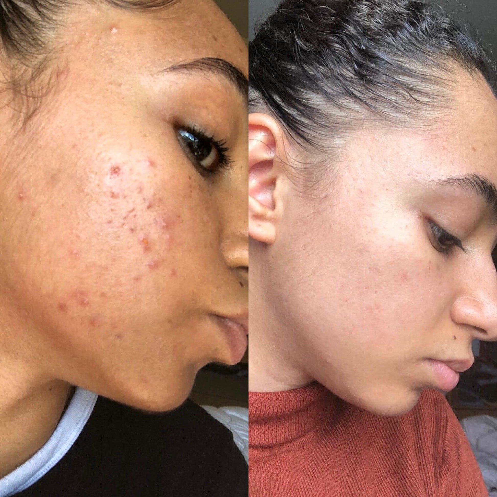 Argan Acne Rehab Serum 30ml Plant Based Formula for Acne Prone Skin