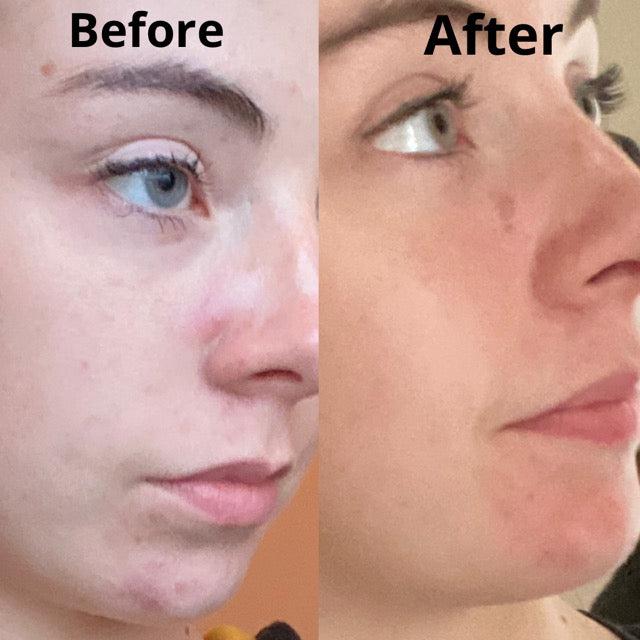 Argan Acne Rehab Serum 30ml Plant Based Formula for Acne Prone Skin