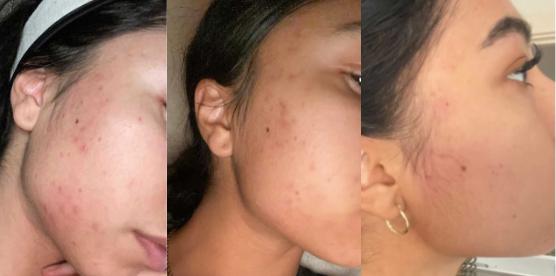 Argan Acne Rehab Serum 30ml Plant Based Formula for Acne Prone Skin