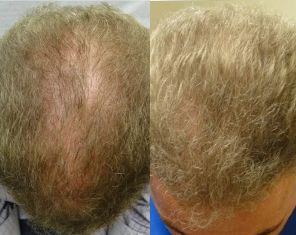 Hair Regrowth Oil for Thinning and Loss