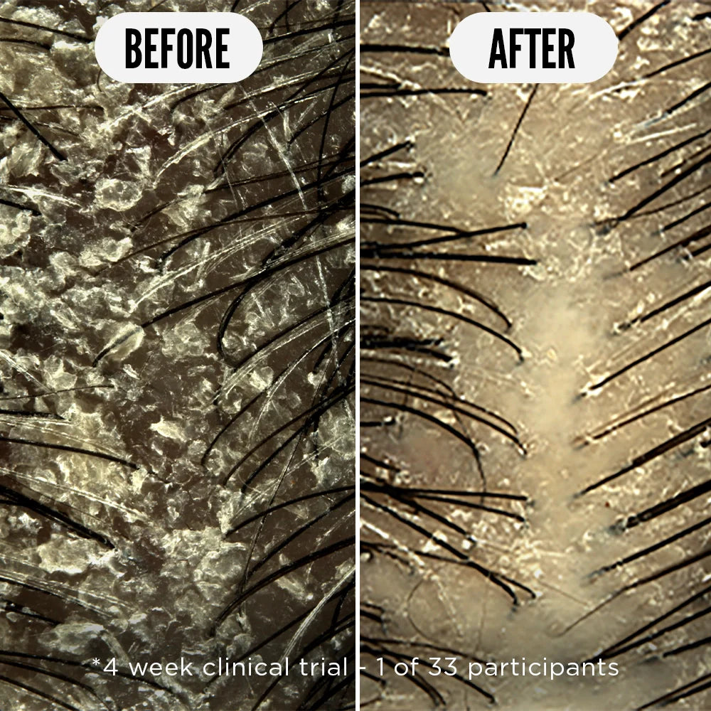 Scalp Tonic 75ml for Flaky Itchy Sensitive Scalp