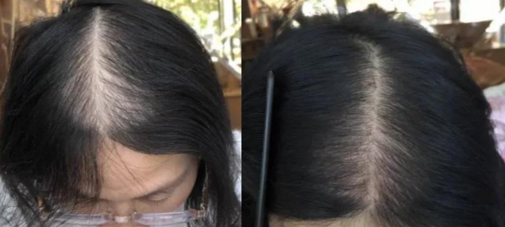 Hair Regrowth Oil for Thinning and Loss