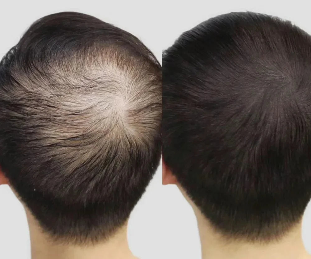 Hair Regrowth Oil for Thinning and Loss