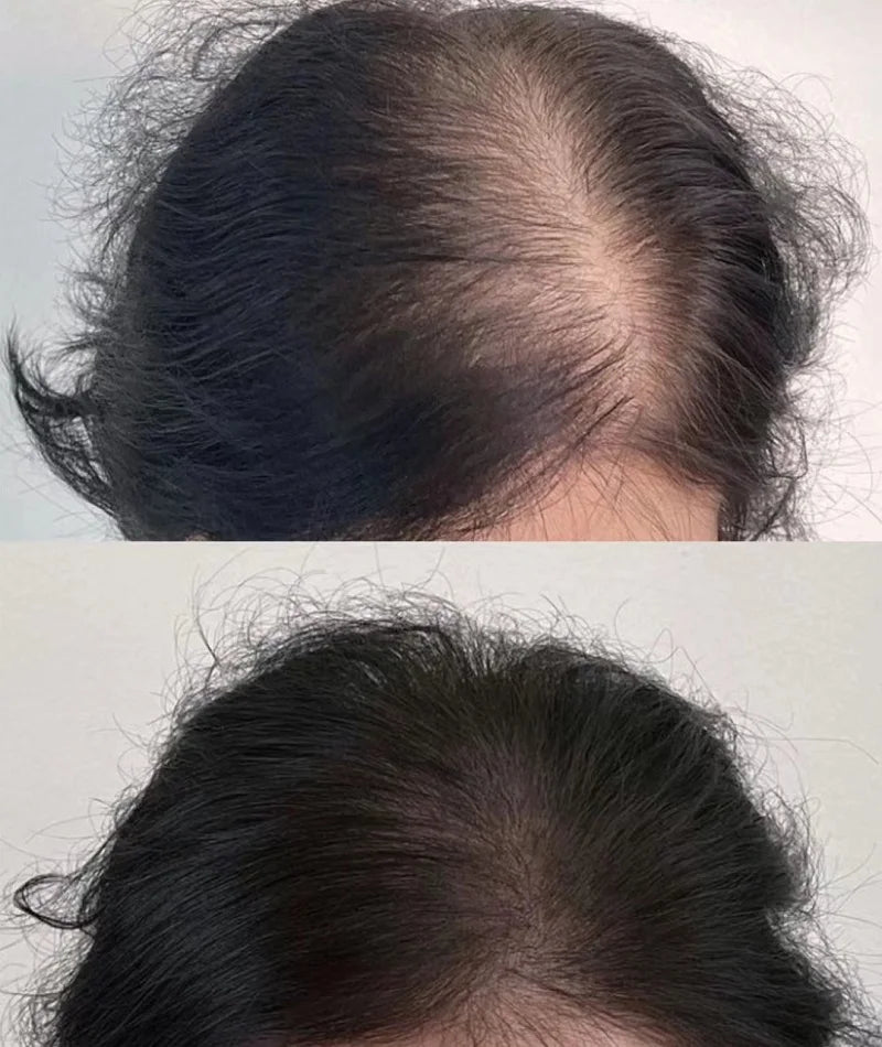 Hair Regrowth Oil for Thinning and Loss